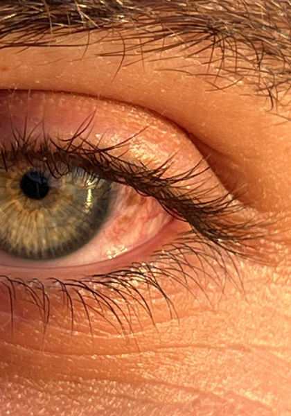 Glaucome